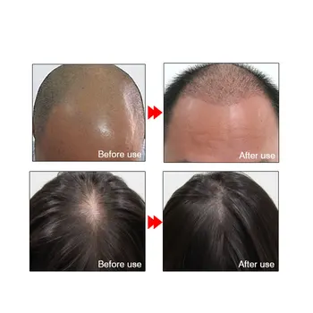 ARTISCARE Plaukų Aliejus Plaukų Keratino Augimo Esmė Produkto Plaukų Priežiūros eterinis Aliejus Skystas Gydymo užkirsti Kelią Plaukų Slinkimas Kokosų aliejus